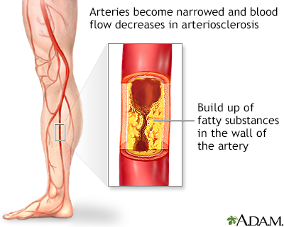 artery disease legs
