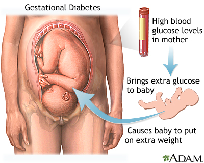 28 weeks pregnant. Gestational Diabetes
