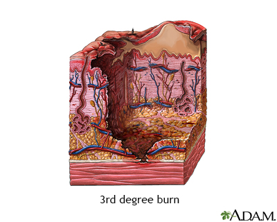 classifications of burns. types Degrees+of+urns