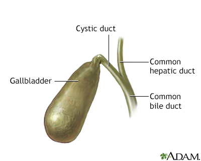 Gallbladder disease gallbladder stones pictures. Gallbladder disease