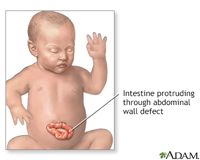 Lump in the abdomen