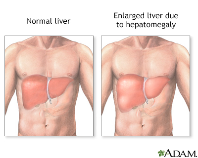 Hemochromatosis is a disorder