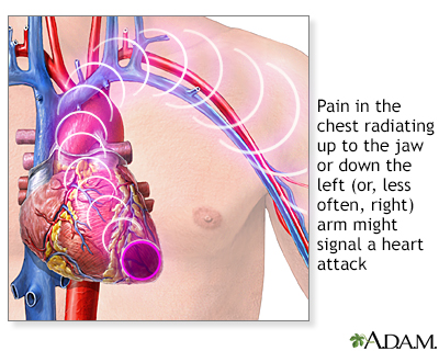 heart attack pain. Heart attack symptoms