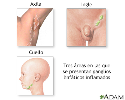 Ganglios linfáticos inflamados
